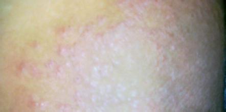 ��Ѣ��֢״�����Լ�������ʳ